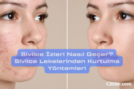 Sivilce İzleri Nasıl Geçer? Sivilce Lekelerinden Kurtulma Yöntemleri