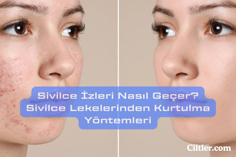 Sivilce İzleri Nasıl Geçer? Sivilce Lekelerinden Kurtulma Yöntemleri