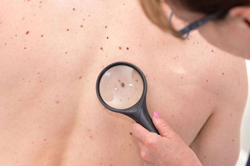 Cilt Deri Kanseri Nedir? İlk Olarak Nasıl Anlaşılır