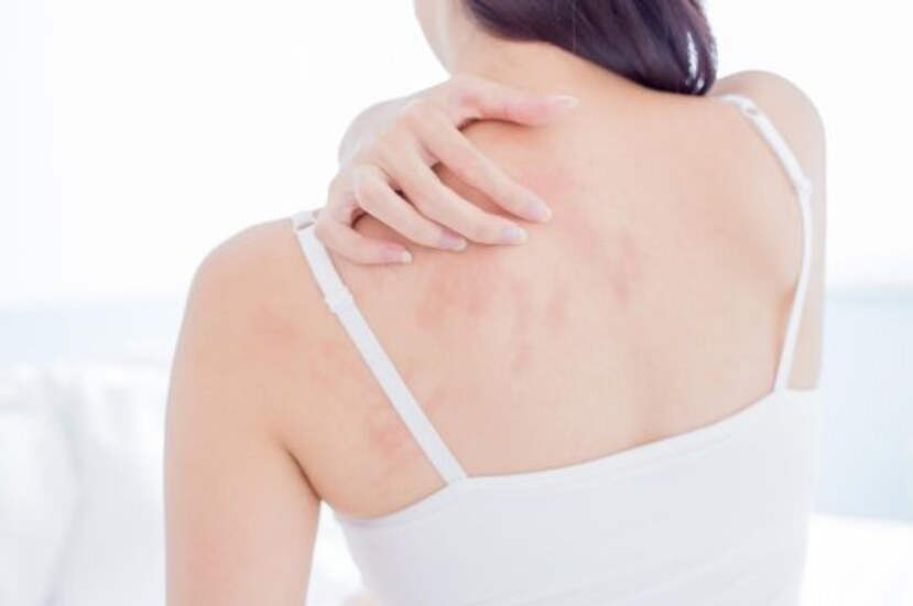 Egzama Nedir? Egzama İçin Ne İyi Gelir