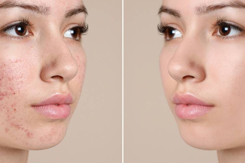 Sivilce (Akne) Nasıl Geçer? İşte En Etkili Yöntemler