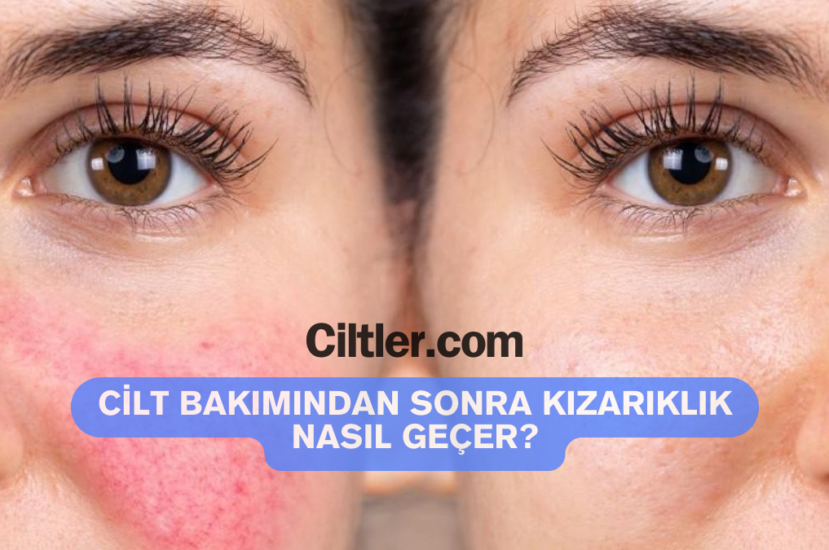 Cilt Bakımından Sonra Kızarıklık Nasıl Geçer?
