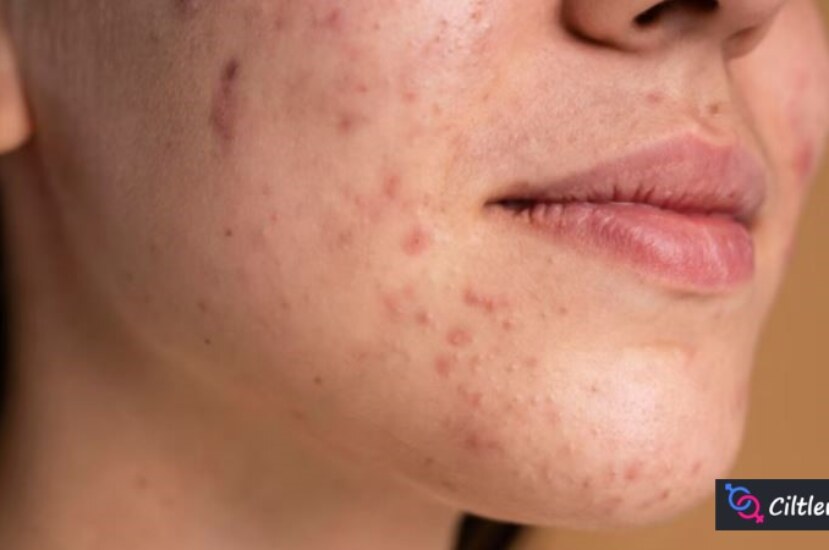 Ciltte Kendiliğinden Çıkan Yaralar