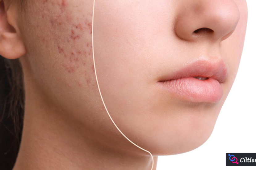 Sivilcelere Hangi Vitamin İyi Gelir