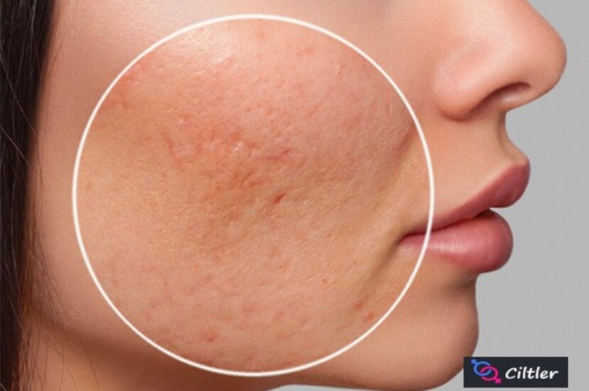 Yüzdeki Çukurlar Doğal Yöntemlerle Nasıl Geçer?