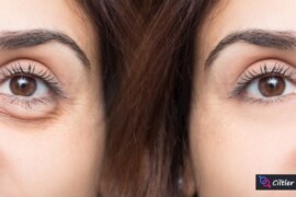 Göz Altı Şişliğine Ne İyi Gelir