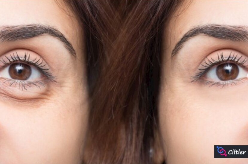 Göz Altı Şişliğine Ne İyi Gelir