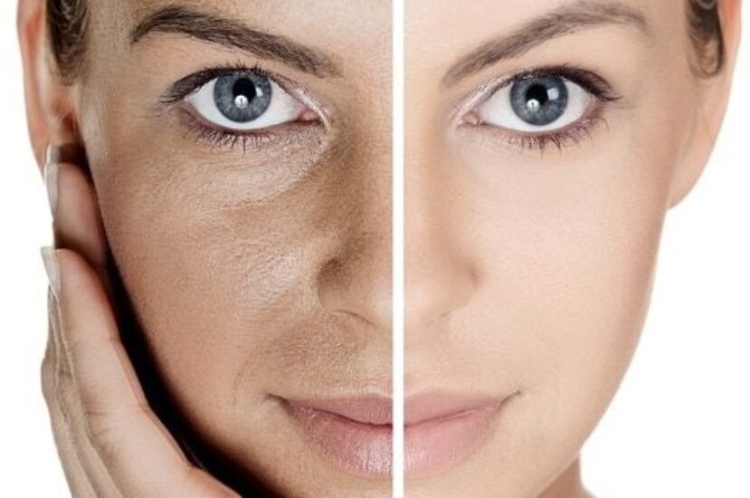 Beyaz Cilt Nasıl Olur? Cildinizi Aydınlatmanın Yolları