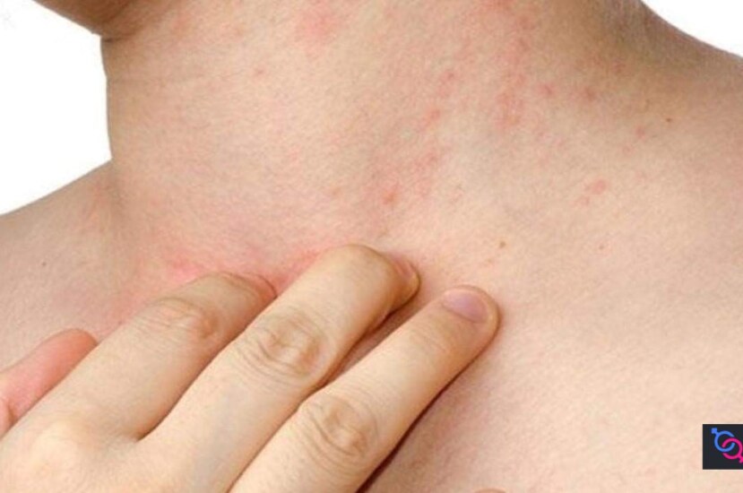 Cilt Alerjilerine Ne İyi Gelir? Doğanın Şifalı Güçleri