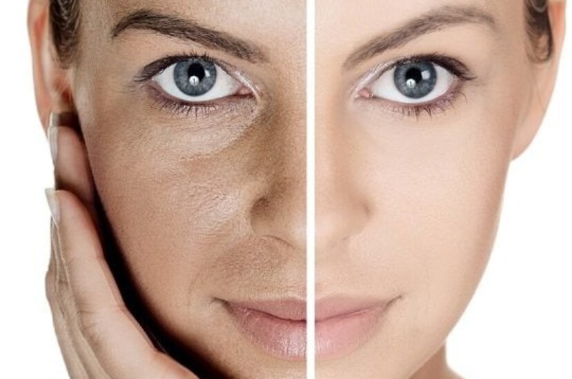 Cilt Beyazlatma Yöntemleri: Doğal ve Etkili Çözümlerle Işıldayın!