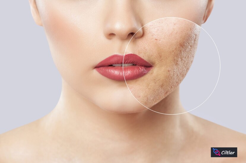 Cilt Delikleri Nasıl Geçer: Etkili Yöntemler ve Doğal Çözümler