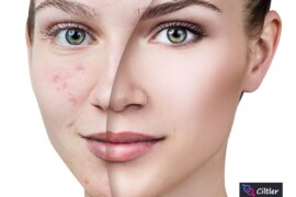 Deri Altında Çıkan Sivilce: Nedenleri ve Etkili Çözümler