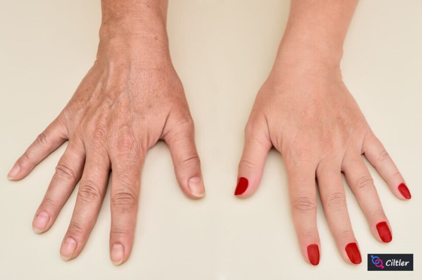 Deri İncelmesi Belirtileri: Cildinizdeki İnce Dikkat Çizgileri