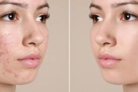 Sivilceyi En Hızlı Ne Kurutur: Doğal Yöntemlerle Hızla İyileşmenin Sırları