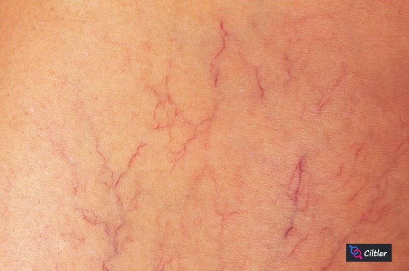 Vücutta Çizik Şeklinde Kızarıklık: Nedenleri ve Tedavi Yöntemleri