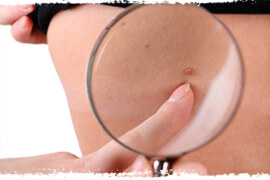 Ciltte Oluşan Et Benleri