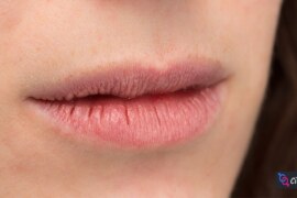 Dudak Çatlamasına Doğal Çözüm: Yumuşacık Dudaklar İçin!