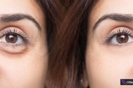 Göz Altı Torbaları Nasıl Geçer? Neden Olur ve Etkili Çözüm Yöntemleri (2025)